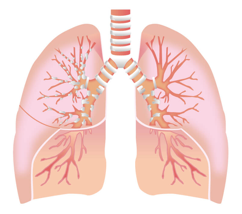 気管支拡張症による咳や痰について 国分寺の鍼灸なら改善率93.5％を誇る東洋はり灸院