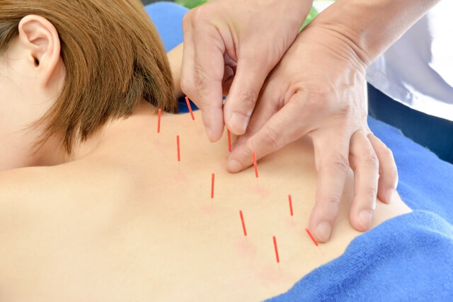 鍼灸